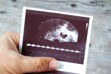 échographie de la grossesse à 5 semaines